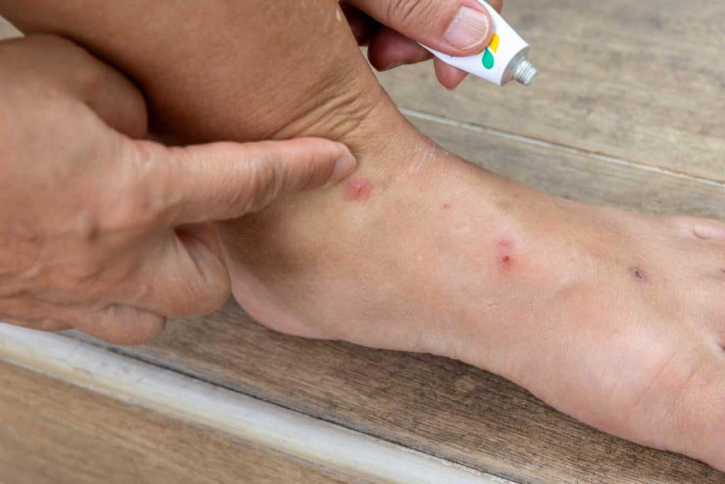 bouton de puce comment reconnaitre traiter et prevenir les piqures efficacement 1