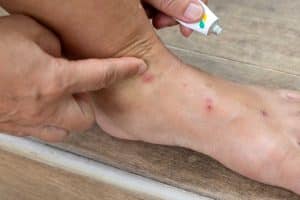 bouton de puce comment reconnaitre traiter et prevenir les piqures efficacement 1