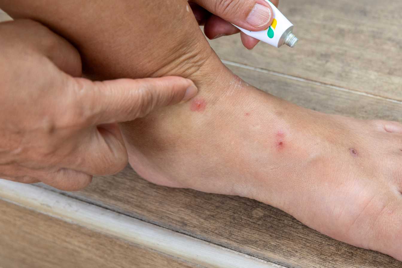 bouton de puce comment reconnaitre traiter et prevenir les piqures efficacement 1